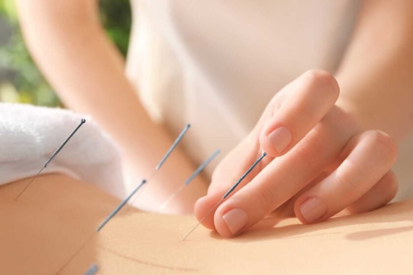 Acupuncture pour maigrir