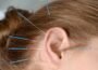 Point d'acupuncture oreille pour maigrir